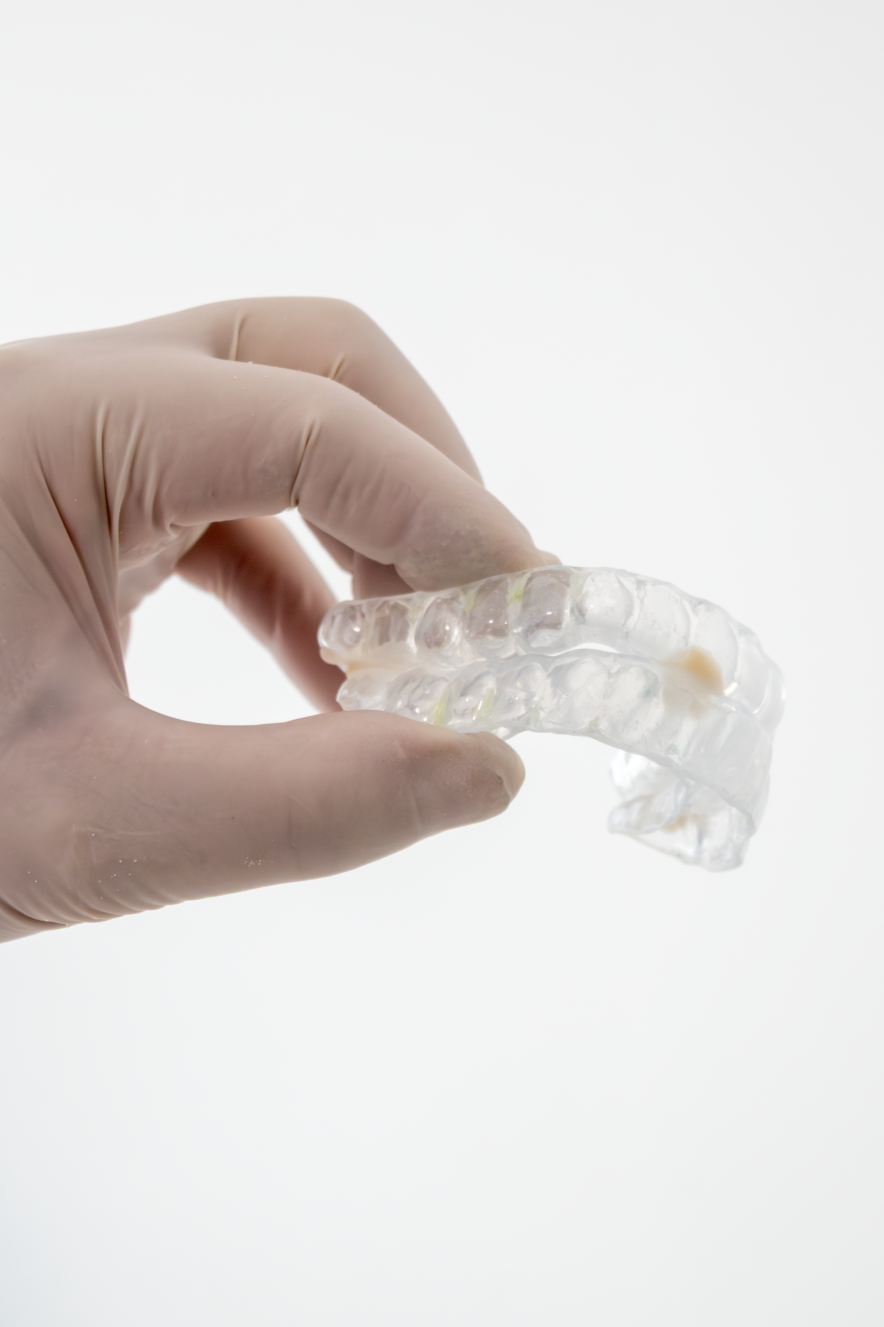 Vista lateral de un Dispositivo de Avance Mandibular confeccionado a medida